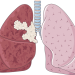 How to Get Back Healthy Lungs After Smoking