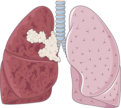How to Get Back Healthy Lungs After Smoking